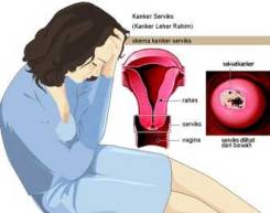 kanker mulut rahim